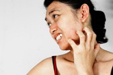 Trời nồm ẩm, gia tăng bệnh da liễu Trời nồm ẩm, gia tăng bệnh da liễu