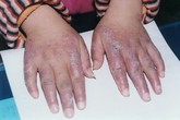Phòng bệnh mùa lạnh: Chiều chuộng làn da “ngứa như điên” thế nào? Phòng bệnh mùa lạnh: Chiều chuộng làn da “ngứa như điên” thế nào?