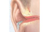 Mùa hè trẻ đi bơi nhiều, đây là cách để giúp trẻ tránh bị viêm tai giữa Mùa hè trẻ đi bơi nhiều, đây là cách để giúp trẻ tránh bị viêm tai giữa