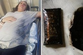 Bà bầu nhập viện vì điện thoại phát nổ trên giường Bà bầu nhập viện vì điện thoại phát nổ trên giường