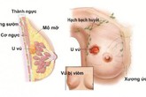 Tắm chung với con gái, mẹ phát hiện điểm bất thường trên ngực nhờ đó cứu sống con Tắm chung với con gái, mẹ phát hiện điểm bất thường trên ngực nhờ đó cứu sống con