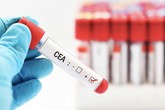 Ưu nhược điểm của các tầm soát ung thư Ưu nhược điểm của các tầm soát ung thư