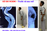 BV Bạch Mai ứng dụng thành công các hệ thống Robot hiện đại trong phẫu thuật, chi phí bằng 1/10 nước ngoài BV Bạch Mai ứng dụng thành công các hệ thống Robot hiện đại trong phẫu thuật, chi phí bằng 1/10 nước ngoài