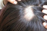 Cách đơn giản phân biệt rụng tóc bình thường và rụng tóc do bệnh lý Cách đơn giản phân biệt rụng tóc bình thường và rụng tóc do bệnh lý