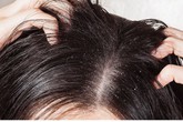 Hãi hùng những cách trị chấy “bá đạo” của người lớn cho trẻ Hãi hùng những cách trị chấy “bá đạo” của người lớn cho trẻ