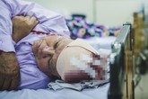 Mổ lấy được cục máu đông gây đột quỵ dài gần 10cm Mổ lấy được cục máu đông gây đột quỵ dài gần 10cm