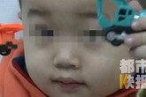 Bé trai 3 tuổi bị mù suốt 10 ngày chỉ vì bị cảm lạnh nhưng không điều trị dứt điểm Bé trai 3 tuổi bị mù suốt 10 ngày chỉ vì bị cảm lạnh nhưng không điều trị dứt điểm