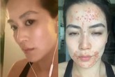 Từ một cô gái có làn da trắng mịn hồng hào, nữ phóng viên mắc chứng bệnh với mụn nổi khắp miệng ai cũng phát sợ Từ một cô gái có làn da trắng mịn hồng hào, nữ phóng viên mắc chứng bệnh với mụn nổi khắp miệng ai cũng phát sợ