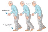 Người cao tuổi bị Parkinson nên biết những điều này Người cao tuổi bị Parkinson nên biết những điều này