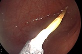 Cháu gái 1 tuổi khạc máu đỏ tươi, bà ngoại hốt hoảng biết lý do Cháu gái 1 tuổi khạc máu đỏ tươi, bà ngoại hốt hoảng biết lý do