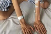 Hội chứng lạ khiến người phụ nữ có chân tay gầy, dài bất thường Hội chứng lạ khiến người phụ nữ có chân tay gầy, dài bất thường