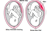 Bánh nhau bong một nửa, em bé non tháng chỉ 1,9kg vẫn mạnh mẽ cất tiếng khóc chào đời Bánh nhau bong một nửa, em bé non tháng chỉ 1,9kg vẫn mạnh mẽ cất tiếng khóc chào đời