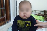 Bé 17 tháng phù mặt bất thường, tăng cân siêu tốc, suy thượng vì bố mẹ cho uống loại thuốc này Bé 17 tháng phù mặt bất thường, tăng cân siêu tốc, suy thượng vì bố mẹ cho uống loại thuốc này
