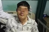 Người đàn ông say rượu nôn ra khối u 10cm, sau đó cố nuốt trở lại Người đàn ông say rượu nôn ra khối u 10cm, sau đó cố nuốt trở lại