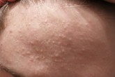 Tổng quan mụn trứng cá Tổng quan mụn trứng cá