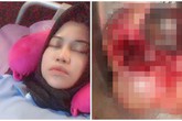 Cô gái có 2 khối u quái ở buồng trứng vì thích ăn loại thực phẩm nhiều người cũng mê Cô gái có 2 khối u quái ở buồng trứng vì thích ăn loại thực phẩm nhiều người cũng mê