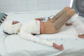Tiếng khóc xé lòng của bé gái xinh xắn bỏng nặng toàn thân vì cồn đổ vào người Tiếng khóc xé lòng của bé gái xinh xắn bỏng nặng toàn thân vì cồn đổ vào người