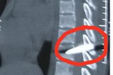Nửa đêm cứu nam thanh niên bị dao đâm xuyên tuỷ, liệt ngay chi dưới Nửa đêm cứu nam thanh niên bị dao đâm xuyên tuỷ, liệt ngay chi dưới