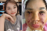 Kiểu làm đẹp hút mỡ chỗ thừa, "đắp đầy" chỗ thiếu thực chất là gì, biến chứng chết người ra sao? Kiểu làm đẹp hút mỡ chỗ thừa, "đắp đầy" chỗ thiếu thực chất là gì, biến chứng chết người ra sao?