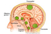 Những dấu hiệu u não hay gặp, điều thứ 3 nhiều người mắc mà không biết Những dấu hiệu u não hay gặp, điều thứ 3 nhiều người mắc mà không biết