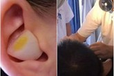Nhét tỏi vào lỗ tai để trị đau tai gây mất ngủ, người đàn ông phải nhận kết đắng Nhét tỏi vào lỗ tai để trị đau tai gây mất ngủ, người đàn ông phải nhận kết đắng