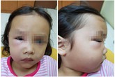 Bé gái suýt chết vì sâu răng, nha sĩ trách cha mẹ hại con vì thói quen tai hại Bé gái suýt chết vì sâu răng, nha sĩ trách cha mẹ hại con vì thói quen tai hại