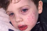 Bé trai 3 tuổi nhiễm virus bệnh tình dục sau nụ hôn vào má Bé trai 3 tuổi nhiễm virus bệnh tình dục sau nụ hôn vào má