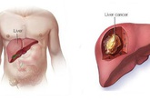 Dưỡng gan đúng hay sai đều bắt đầu từ việc ăn uống, đây là 4 việc bác sĩ rất tán thành Dưỡng gan đúng hay sai đều bắt đầu từ việc ăn uống, đây là 4 việc bác sĩ rất tán thành