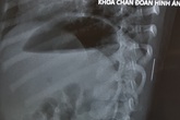 Tìm ra "thủ phạm" khiến bé gái sốt cao kéo dài không ai nghĩ tới Tìm ra "thủ phạm" khiến bé gái sốt cao kéo dài không ai nghĩ tới