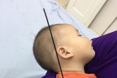 Nan ô đâm xuyên cánh tay bé 6 tháng tuổi Nan ô đâm xuyên cánh tay bé 6 tháng tuổi