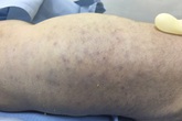 Bé sơ sinh tử vong do nhiễm virus CMV Bé sơ sinh tử vong do nhiễm virus CMV