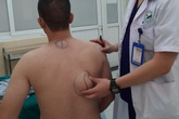 Uống nhiều rượu, cơ thể nam bệnh nhân biến đổi với những khối u lớn ở lưng Uống nhiều rượu, cơ thể nam bệnh nhân biến đổi với những khối u lớn ở lưng