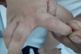 Ký sinh trùng lúc nhúc dưới lớp da tổn thương của bệnh nhi Ký sinh trùng lúc nhúc dưới lớp da tổn thương của bệnh nhi