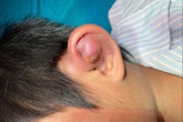 Cứu bé trai ở vùng lũ bị viêm sụn vành tai Cứu bé trai ở vùng lũ bị viêm sụn vành tai