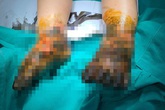 Bé trai bị nhiễm trùng nặng hai chân vì đắp thuốc nam Bé trai bị nhiễm trùng nặng hai chân vì đắp thuốc nam