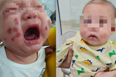 Bé trai khoẻ mạnh bỗng xuất huyết tím đen khắp người, ai ngờ mắc bệnh rất hiếm, thế giới chỉ 300 người bị Bé trai khoẻ mạnh bỗng xuất huyết tím đen khắp người, ai ngờ mắc bệnh rất hiếm, thế giới chỉ 300 người bị