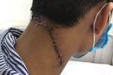 Hải Phòng: "Báo động đỏ" cứu sống nam thanh niên bị vết chém dài 20cm ở cổ Hải Phòng: "Báo động đỏ" cứu sống nam thanh niên bị vết chém dài 20cm ở cổ