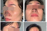 Tiêm filler làm đẹp, nữ bệnh nhân mưng mủ ở mũi, suýt mù mắt Tiêm filler làm đẹp, nữ bệnh nhân mưng mủ ở mũi, suýt mù mắt
