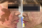 Người phụ nữ bị tai biến vì trị nám ở spa Người phụ nữ bị tai biến vì trị nám ở spa