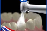 Răng sâu nhẹ, sâu lỗ nhỏ có nên hàn trám không? Răng sâu nhẹ, sâu lỗ nhỏ có nên hàn trám không?