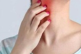 Tiền ung thư gan "không đau", xuất hiện "1 ngứa, 2 hôi và 2 đỏ" cần đi khám gan ngay Tiền ung thư gan "không đau", xuất hiện "1 ngứa, 2 hôi và 2 đỏ" cần đi khám gan ngay