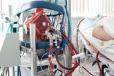 Bác gái bệnh nhân 17 trở nặng, chuyên gia hội chẩn liên tục, xem xét đặt lại ECMO Bác gái bệnh nhân 17 trở nặng, chuyên gia hội chẩn liên tục, xem xét đặt lại ECMO