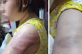 Tường trình của cô giáo đánh học trò bầm tím tay do viết bài chậm ở Nam Định Tường trình của cô giáo đánh học trò bầm tím tay do viết bài chậm ở Nam Định