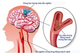 Giải pháp hỗ trợ giảm nguy cơ tai biến cho người cao huyết áp Giải pháp hỗ trợ giảm nguy cơ tai biến cho người cao huyết áp