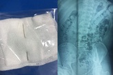 Kim khâu chạy khắp người, đâm thủng gan và dạ dày Kim khâu chạy khắp người, đâm thủng gan và dạ dày