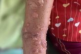 Em bé bị bỏng sứa độc khi tắm biển Em bé bị bỏng sứa độc khi tắm biển