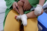 Bé trai bỏng nặng bộ phận sinh dục vì ngã vào nồi canh Bé trai bỏng nặng bộ phận sinh dục vì ngã vào nồi canh