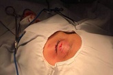 Bé trai 9 tuổi bị ghi đông xe đâm vào mắt Bé trai 9 tuổi bị ghi đông xe đâm vào mắt
