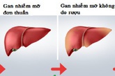 Bé trai mới 8 tuổi đã phát hiện bị gan nhiễm mỡ Bé trai mới 8 tuổi đã phát hiện bị gan nhiễm mỡ