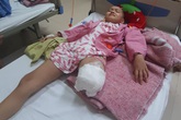 Cô bé mắc ung thư xương Phương Chi đã phải cắt một bên chân Cô bé mắc ung thư xương Phương Chi đã phải cắt một bên chân